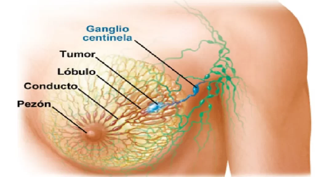 cáncer de mama en las mujeres embarazadas